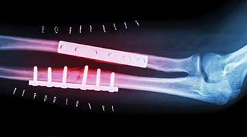 X-ray with surgical screws